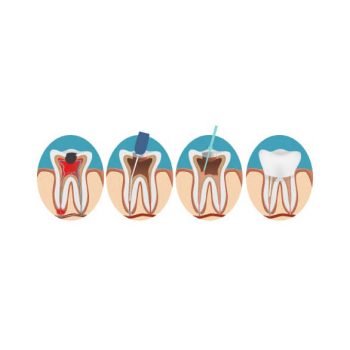 Root Canals Graphic