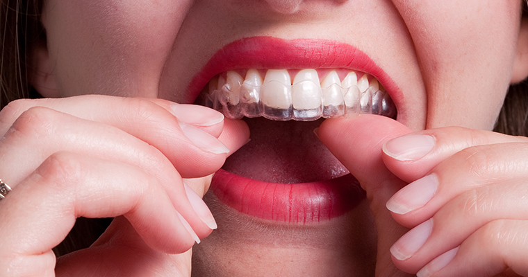 SureSmile Aligners are a popular options for straightening teeth.